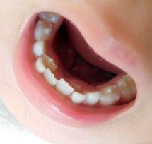 子供の歯並び相談