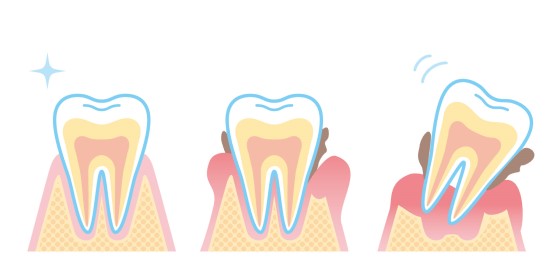 歯周病1-3